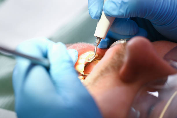 Best Emergency Root Canal Treatment in Thornville, OH