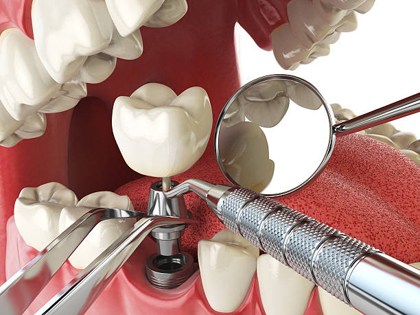 Best Emergency Tooth Extraction in Thornville, OH